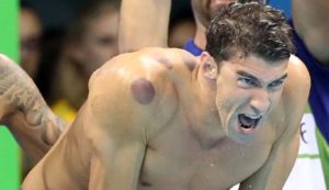 Phelps cupping
